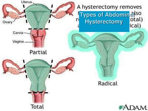 abdominal hysterectomy in chesterfield